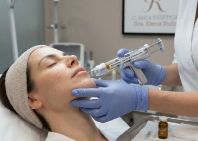 Mesoterapia facial